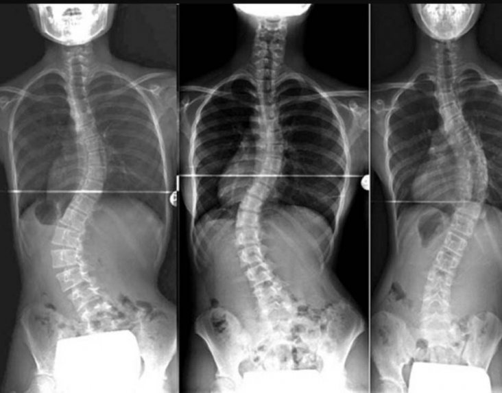 Ilustración de escoliosis para Pilates para escoliosis