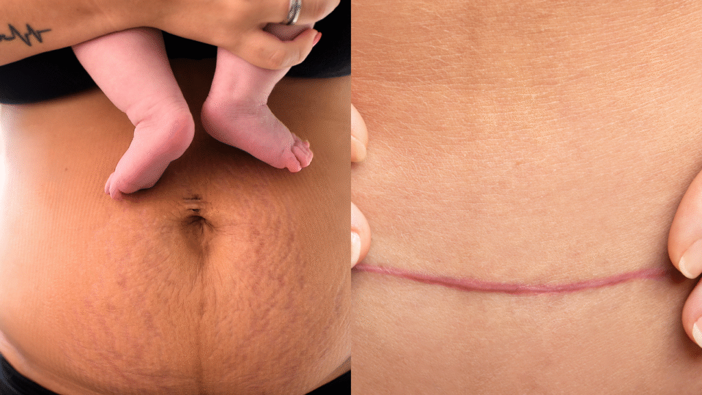 musculatura abdominal y el suelo pélvico después del embarazo.